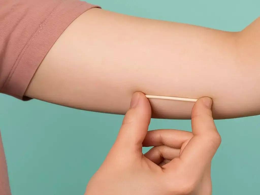 Implante contraceptivo subdérmico Implanon no braço